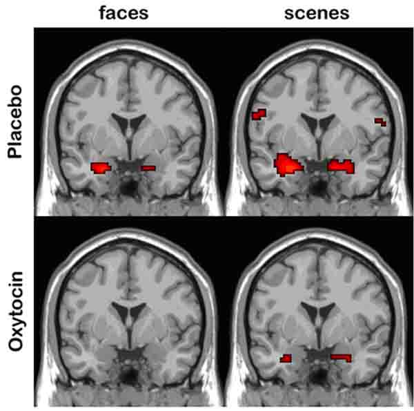 Amygdala fMRI