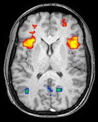 Frontal Lobes fMRI