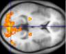 fMRI scan neuroimaging