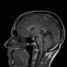 MRI scan neuroimaging