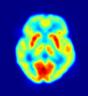 PET scan neuroimaging